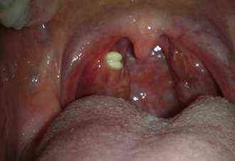 u-rebenka-odna-mindalina-bol-she-drugoy-14-9078375